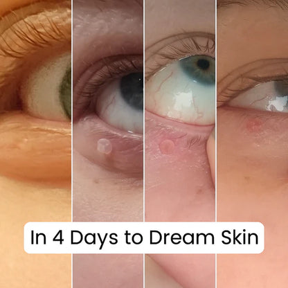 Skin Tag Remover Kit