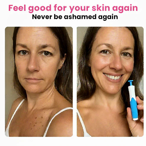 Skin Tag Remover Kit