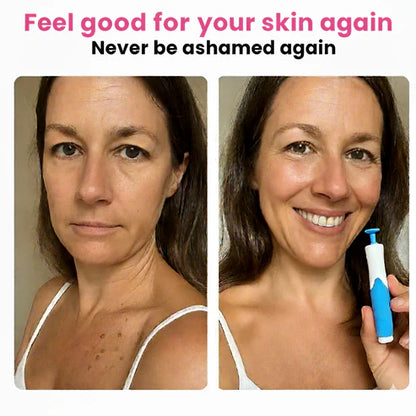 Skin Tag Remover Kit