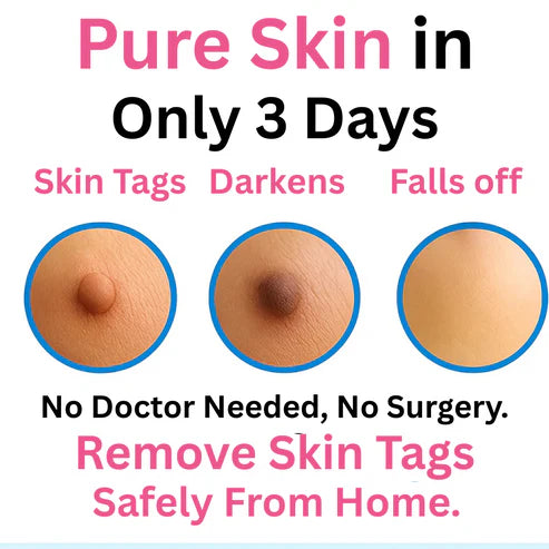 Skin Tag Remover Kit