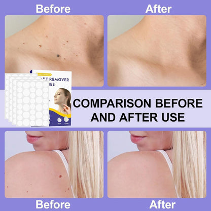 Wart Remover Patches