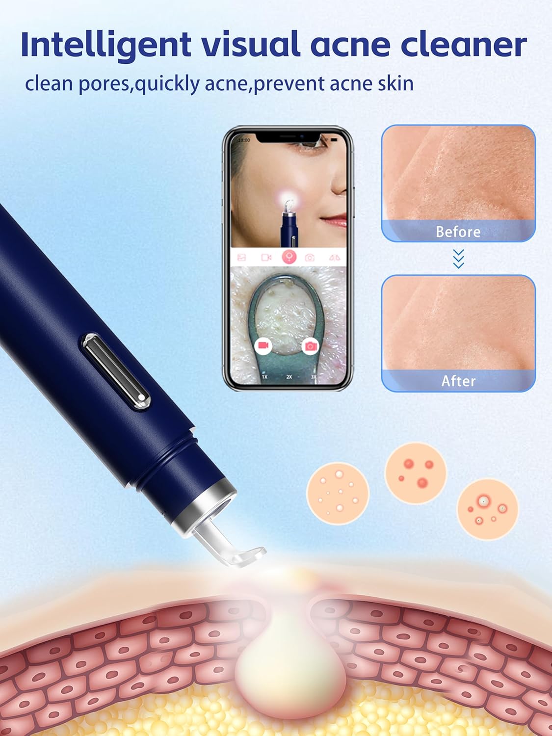 Blackhead Remover